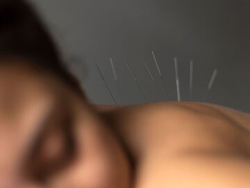 Acupuncture: Unveiling the Science and Surprising Benefits